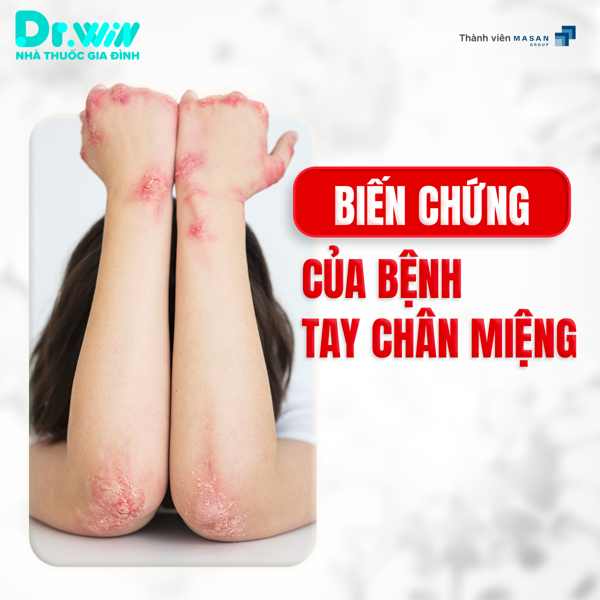 NHỮNG ĐIỀU CẦN BIẾT VỀ BỆNH TAY CHÂN MIỆNG 6