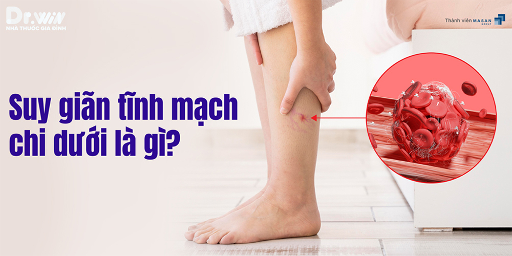 SUY GIÃN TĨNH MẠCH CHI DƯỚI 1